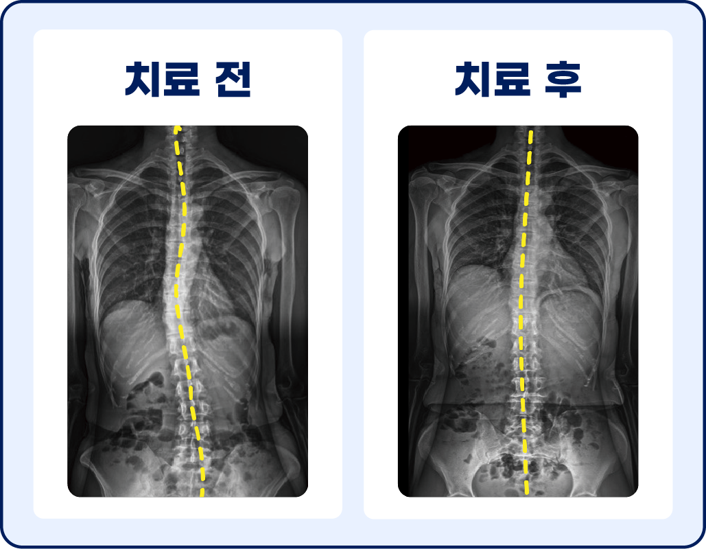 자세 교정 전/후